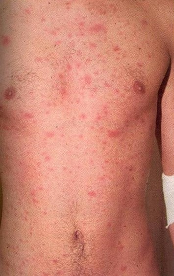 acute hiv rash chest