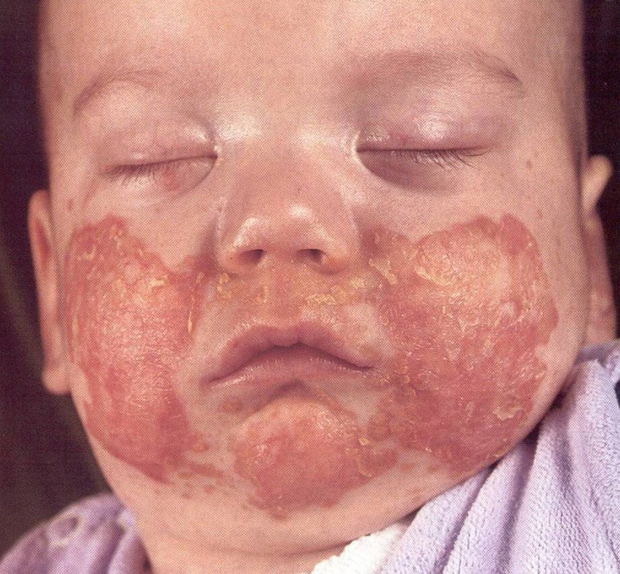 sick baby with a rash