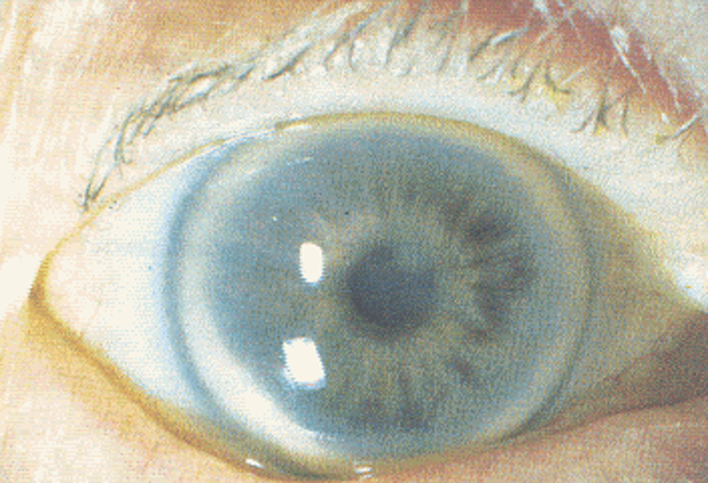 Diagnoses include arcus senilis and cataract.