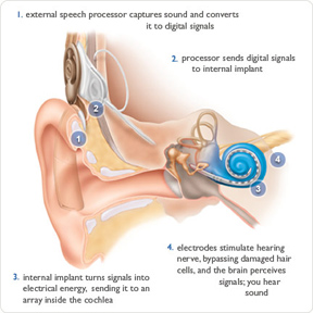 Image of Cochlead Implant Showing steps above